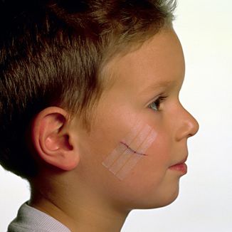 Viscoplast Steri-Strip, paski do zamykania ran, 8 sztuk - 6 - zdjęcie produktu